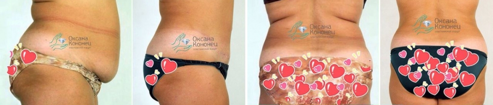 Убрать живот после родов Оксана Кононец