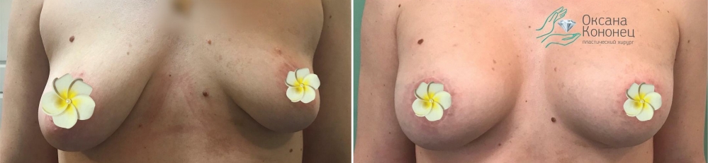 Пластика груди после родов Оксана Кононец