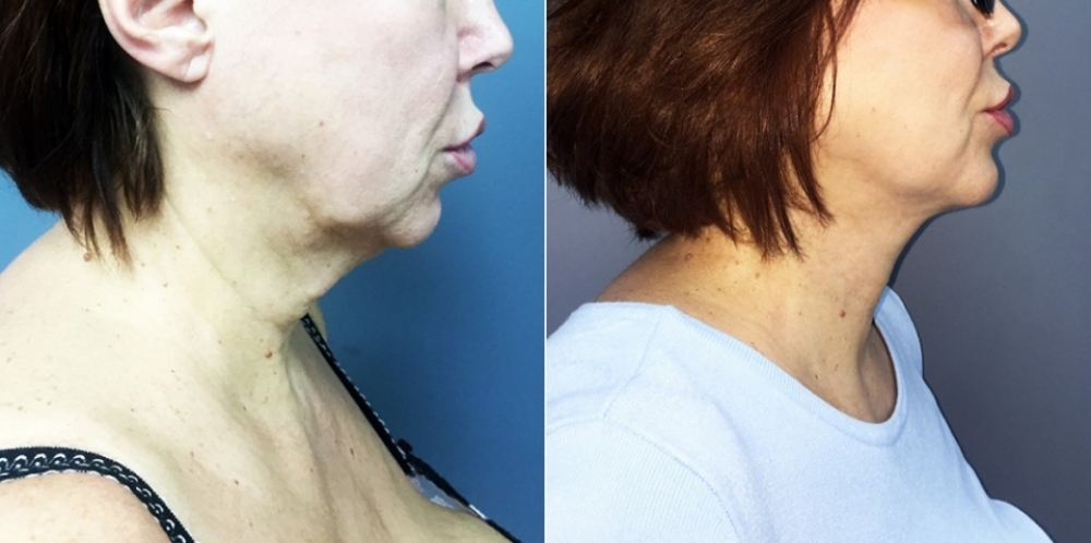 Пациентка Светланы Пшонкиной до и после омоложения шеи