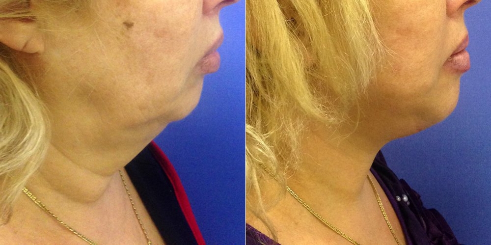 Пациентка Светланы Пшонкиной до и после омоложения шеи