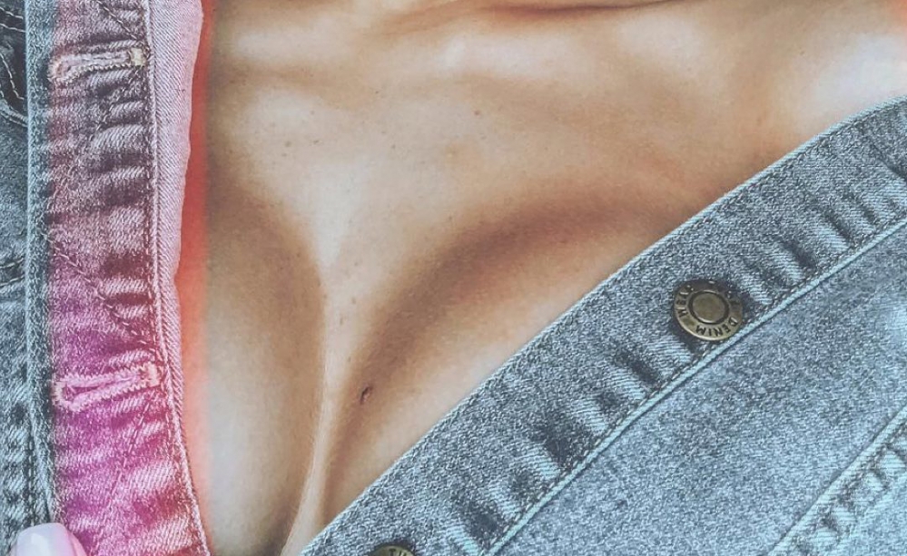 Пациентка Карена Пайтяна после увеличения груди