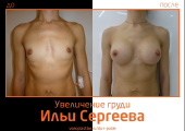 Фото до и после увеличения очень маленькой груди у доктора Ильи Сергеева.