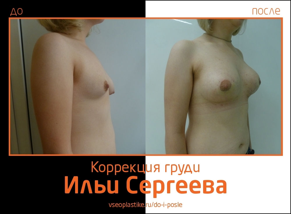 Илья Сергеев.  Фото до и после коррекции асимметрии груди