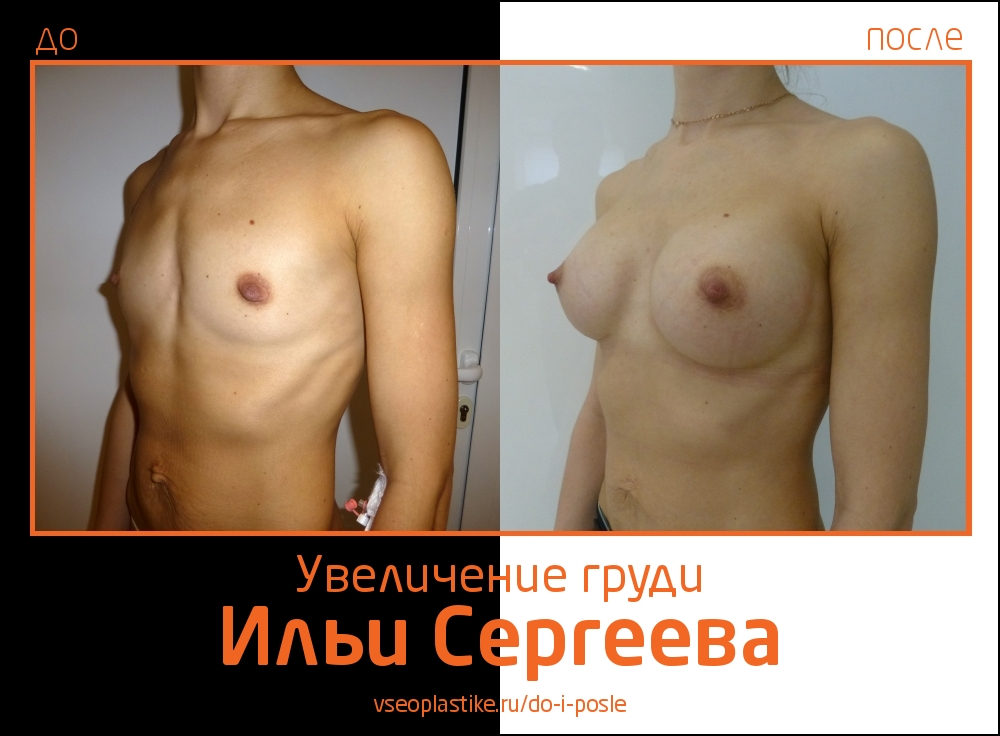 Фото до и после увеличения молочных желез у доктора Ильи Сергеева