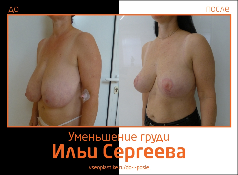 Илья Сергеев.  Фото до и после уменьшения и подтяжки груди