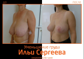 Илья Сергеев.  Фото до и после уменьшения и подтяжки груди