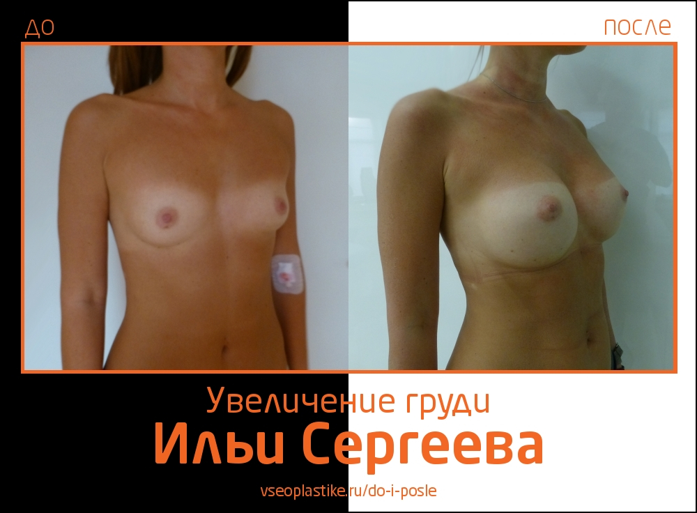 Фото до и после увеличения груди у Ильи Сергеева