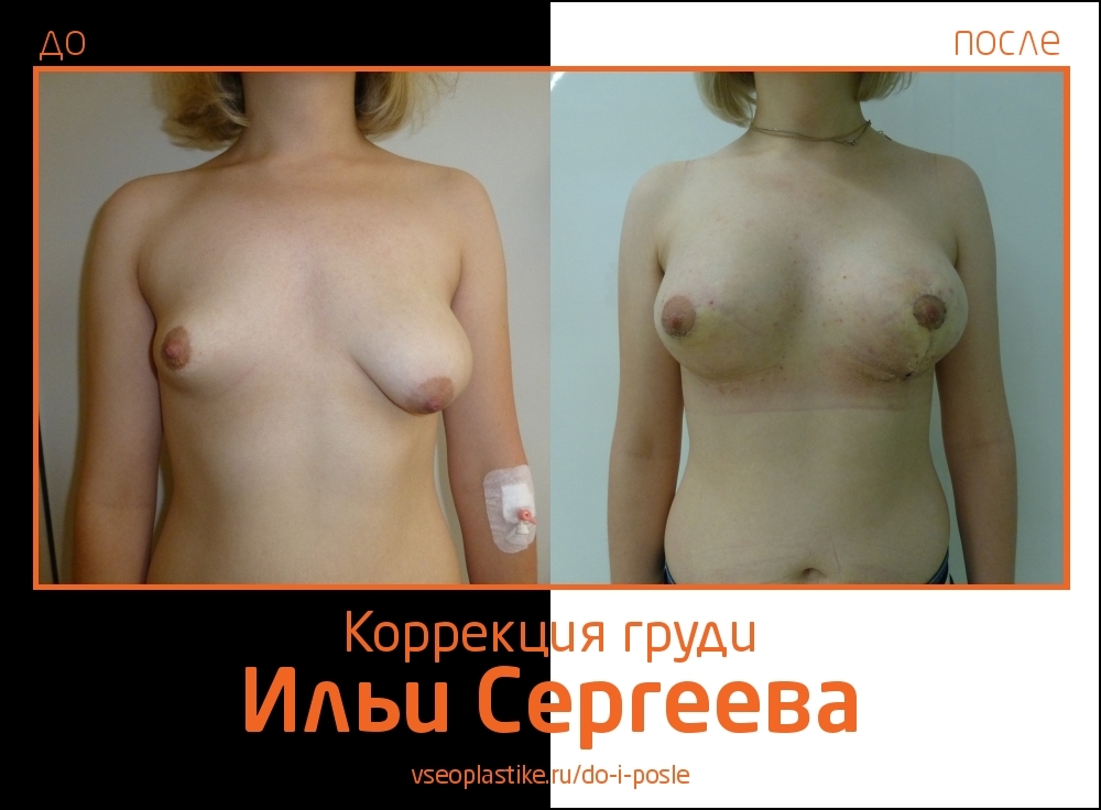 Илья Сергеев.  Фото до и после устранения асимметрии груди