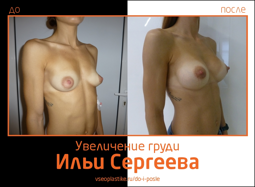 Илья Сергеев.  Фото до и после увеличения молочных желез