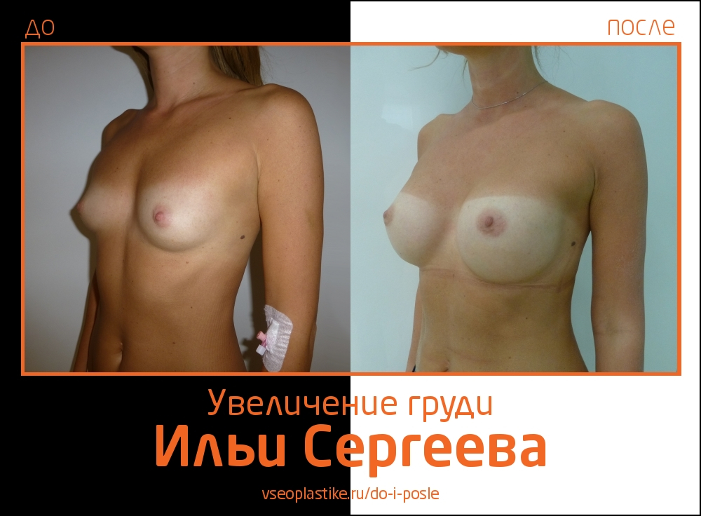 Фото до и после увеличения молочных желез у Ильи Сергеева