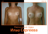 Илья Сергеев.  Фото до и после увеличения молочных желез