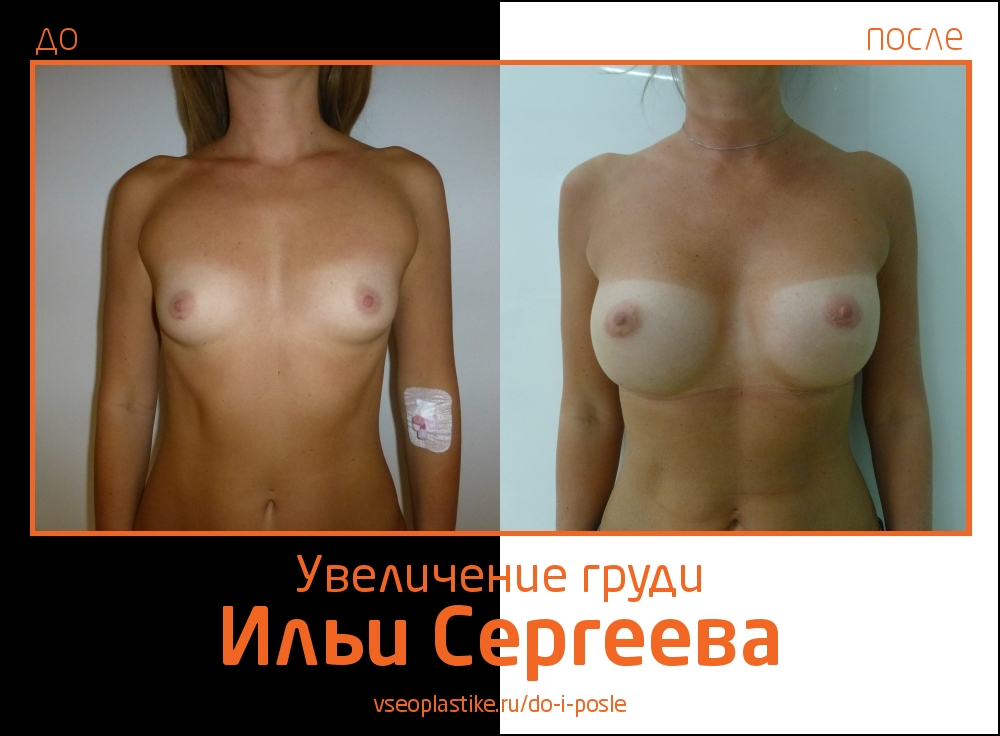 Фото до и после увеличения груди у пластического хирург Ильи  Сергеева