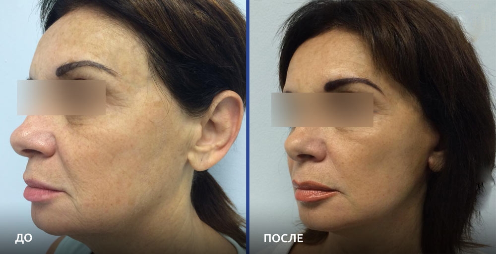 Фото до и после омоложения у пластического хирурга Алексея Гварамии