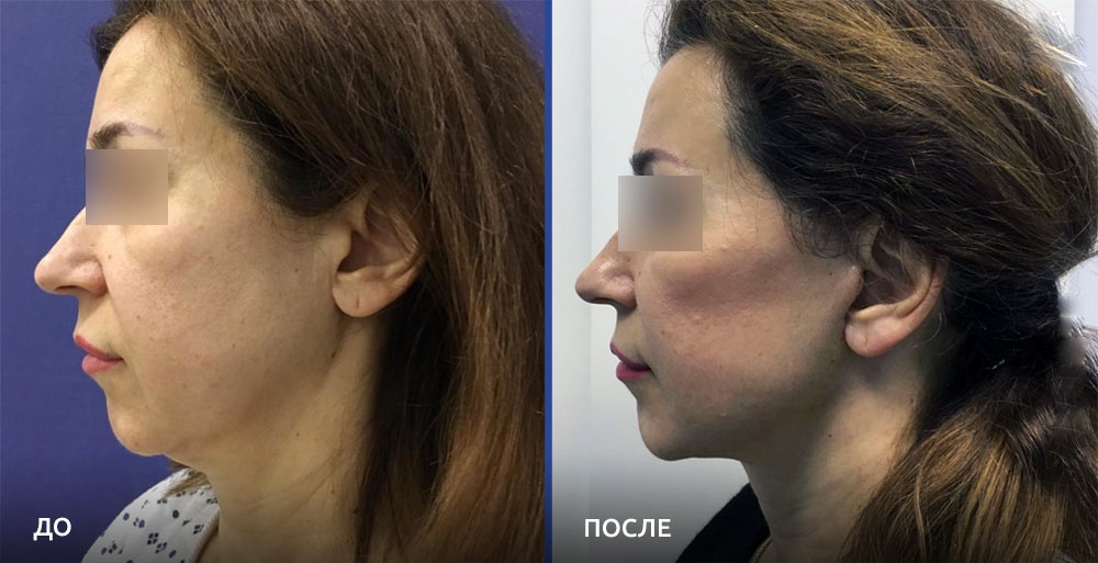 Фото до и после омоложения у доктора Алексея Гварамии