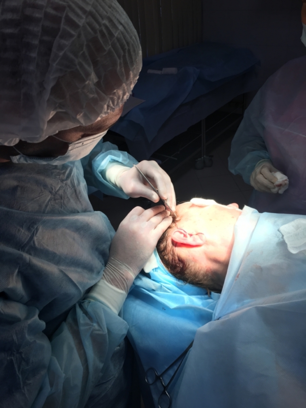 Выполнение разреза в ушной раковине перед SMAS-подтяжкой