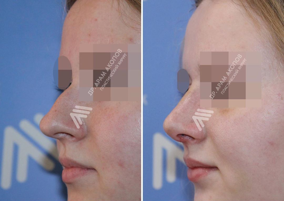 Арам Акопов ринопластика