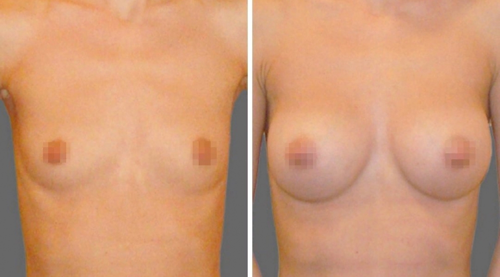 Светлана Пшонкина увеличение груди