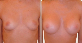 Светлана Пшонкина увеличение груди