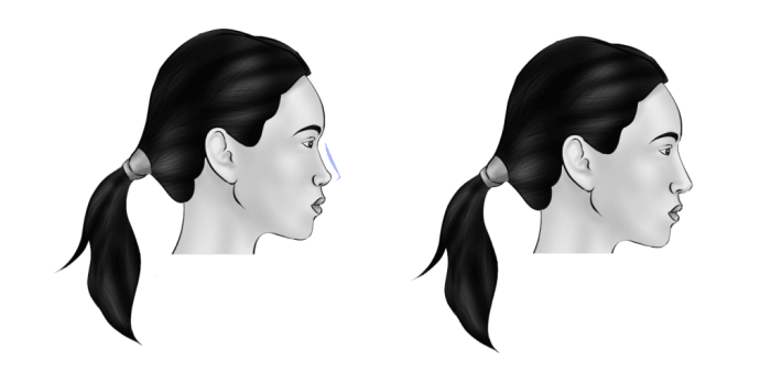 Назальные импланты