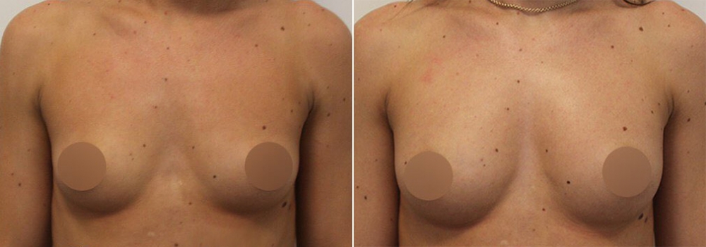 Липотрансфер груди Арслан Пенаев