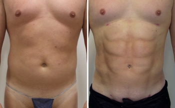 Липотрансфер Арслан Пенаев