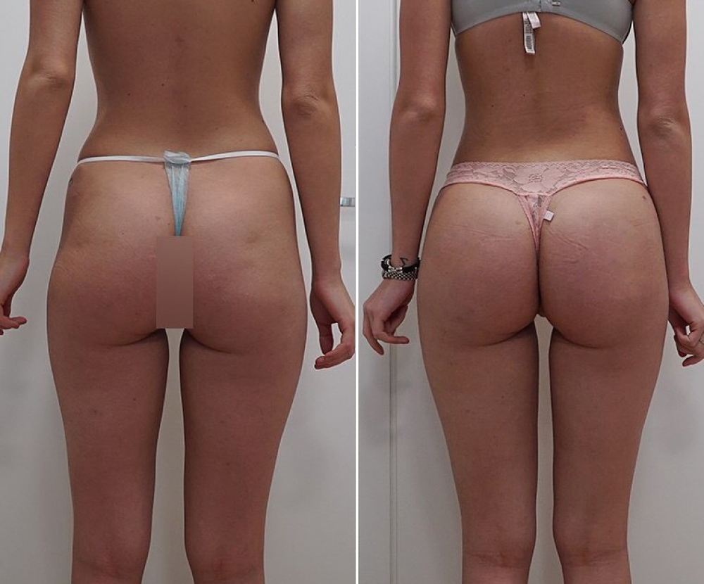 Липомоделирование ягодиц