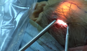 Доступ при эндолифтинге лица