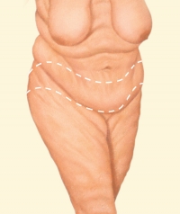 Бодилифтинг