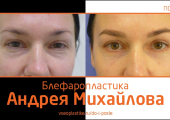 Андрей Михайлов. До и после блефаропластики