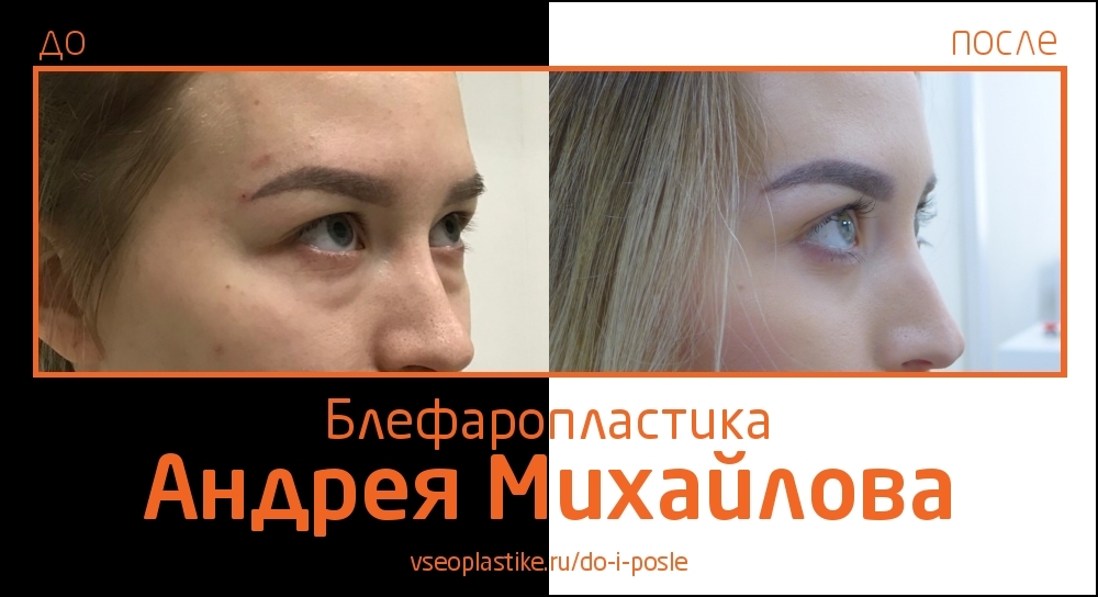 Николай анатольевич до и после пластики