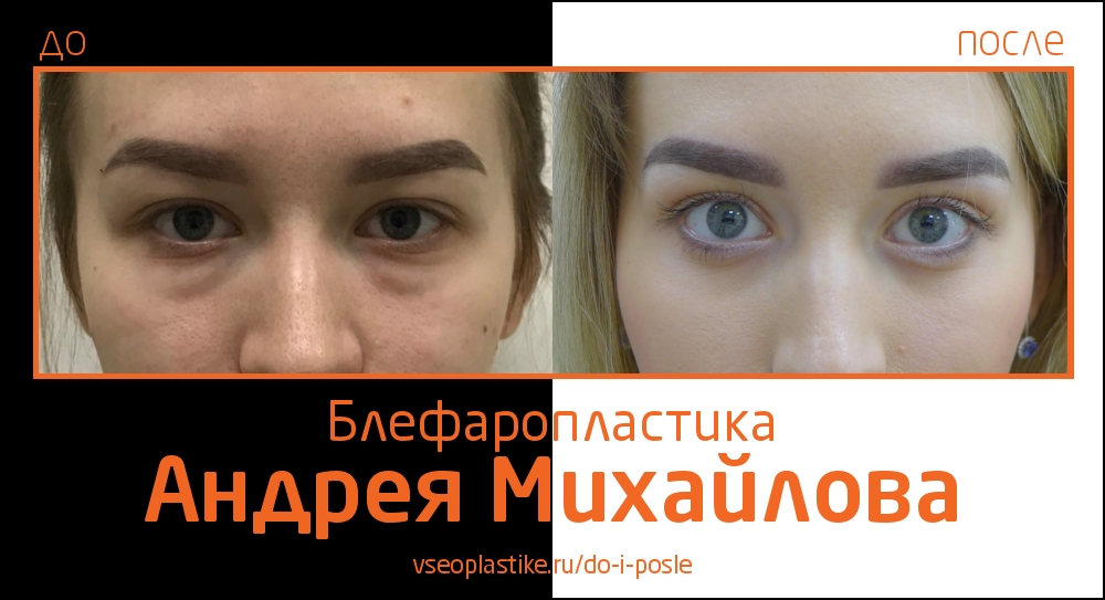 Пластический хирург Андрей Михайлов. До и после блефаропластики