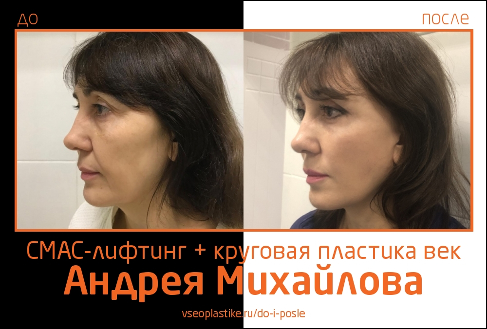 Доктор Андрей Михайлов. Фото до и после СМАС-лифтинга и круговой блефаропластики