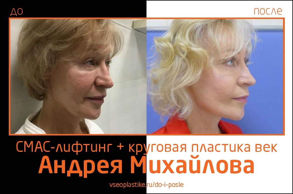 Андрей Михайлов. Фото до и после СМАС-лифтинга и круговой блефаропластики