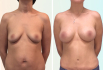 Фото пациентки до и после пластики груди у доктора Дмитрия Рябцева
