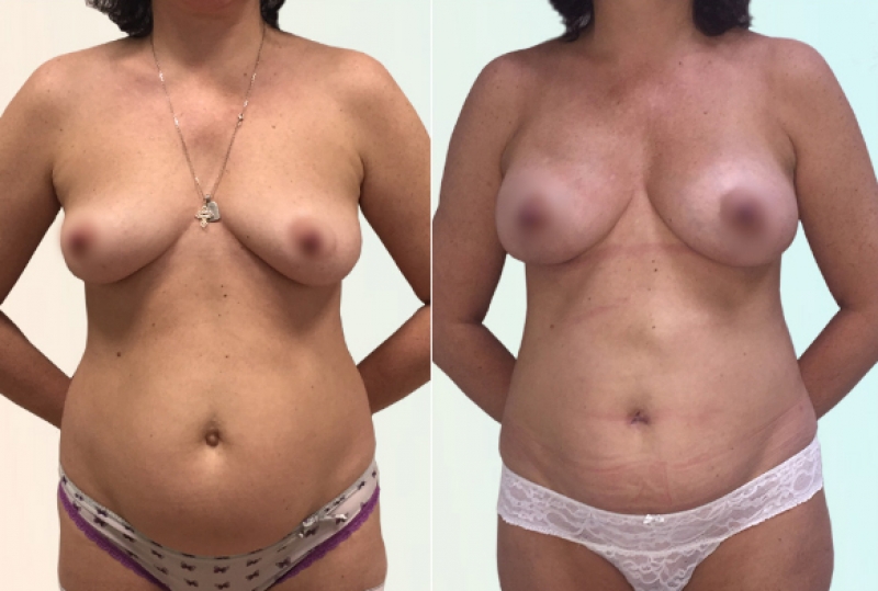 Фото пациентки до и после маммопластики у доктора Рябцева