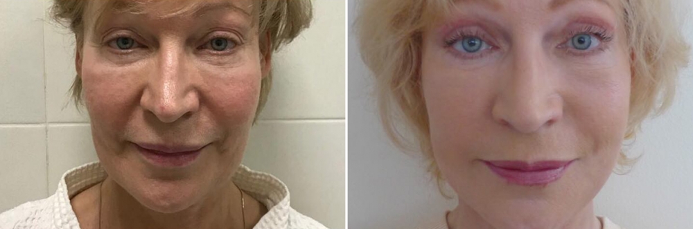 Аедрей Михайлов СМАС-лифтинг