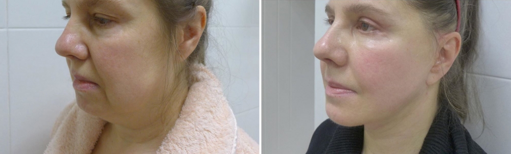 1,5 месяца после Смас подтяжка лица, подтяжка и липосакция шеи, липомоделирование подбородочной области, круговая блефаропластика