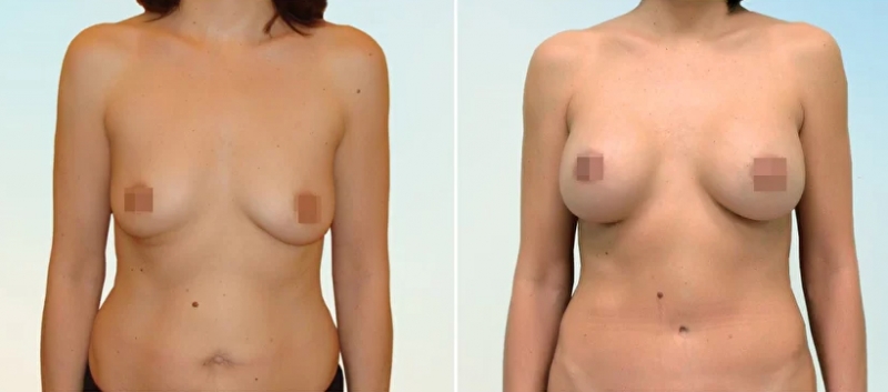 Фото пациентки до и после пластики груди у доктора Рябцева