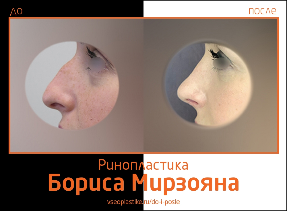 Борис Мирзоян. Фото пациентки до и после пластики носа