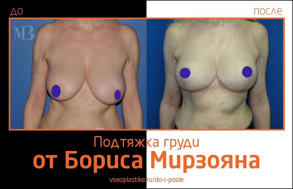 Борис Мирзоян. Фото пациентки до и после мастопексии
