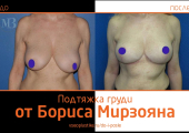 Борис Мирзоян. Фото до и после мастопексии