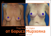 Борис Мирзоян. Фото до и после подтяжки груди