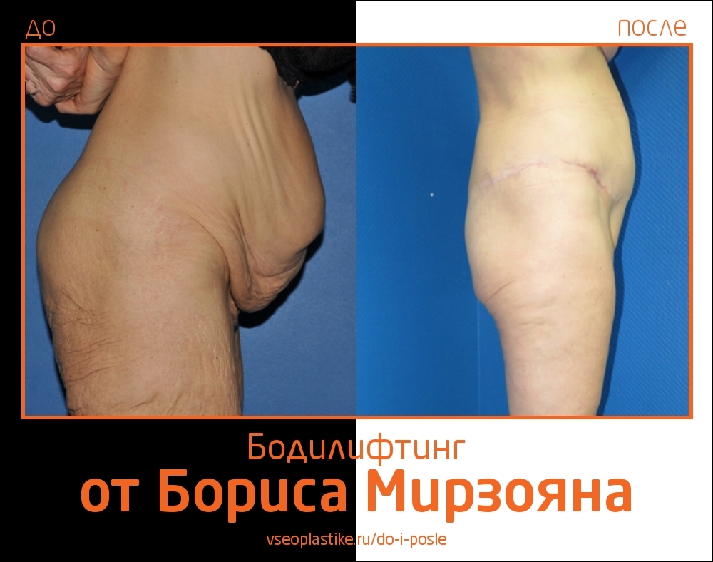 Доктор Борис Мирзоян. Фото до и после бодилифтинга