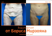 Борис Мирзоян. Фото до и после бодилифтинга