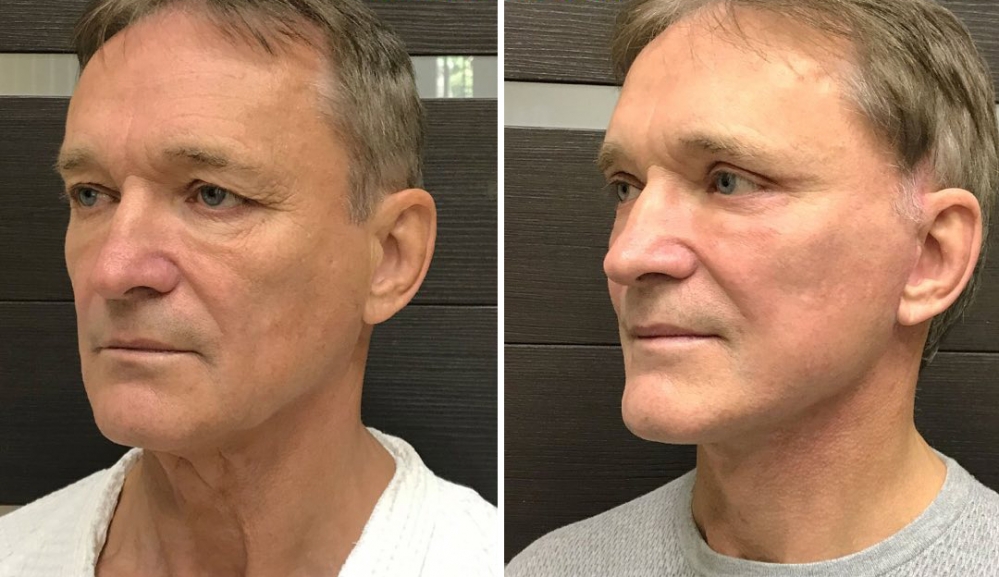 Фото пациента до и после фейслифтинга у доктора Ольги Ованесовой