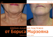 Борис Мирзоян. До и после шейно-лицевой подтяжки