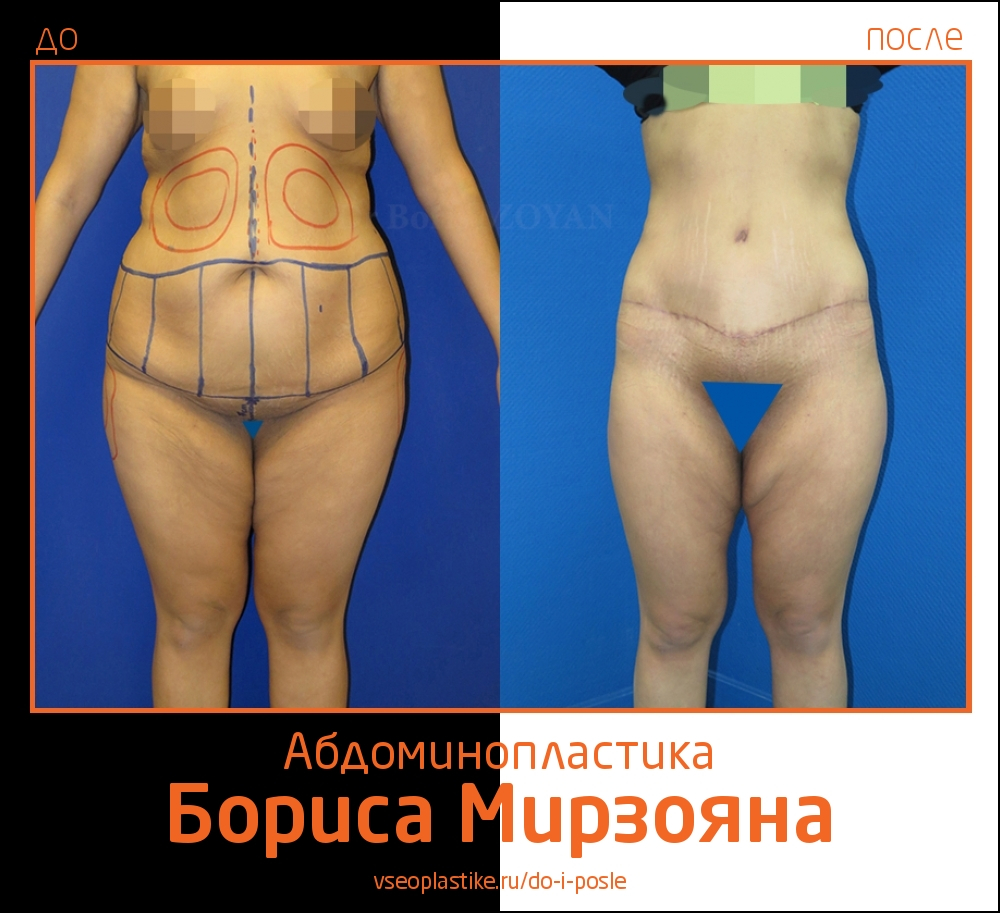 Борис Мирзоян. Фото до и после абдоминопластики