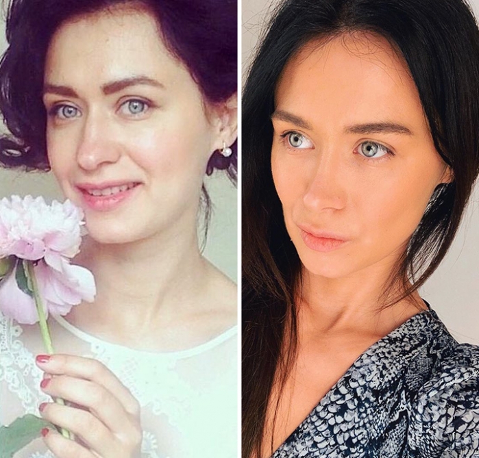 Фото до и после ринопластики у доктора Валерия Стайсупова