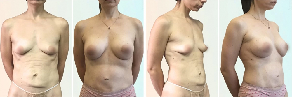 Увеличение груди со скидкой Дмитрий Рябцев