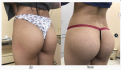 Фото до и после увеличения ягодиц у доктора Дмитрия Крысина